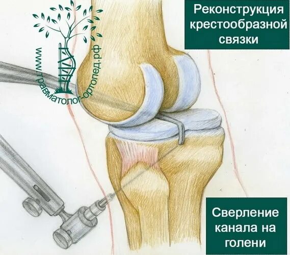 Ангуляция задней крестообразной связки. Реконструкция крестообразной связки. Компрессионное повреждение колена. Травма крестообразной связки.