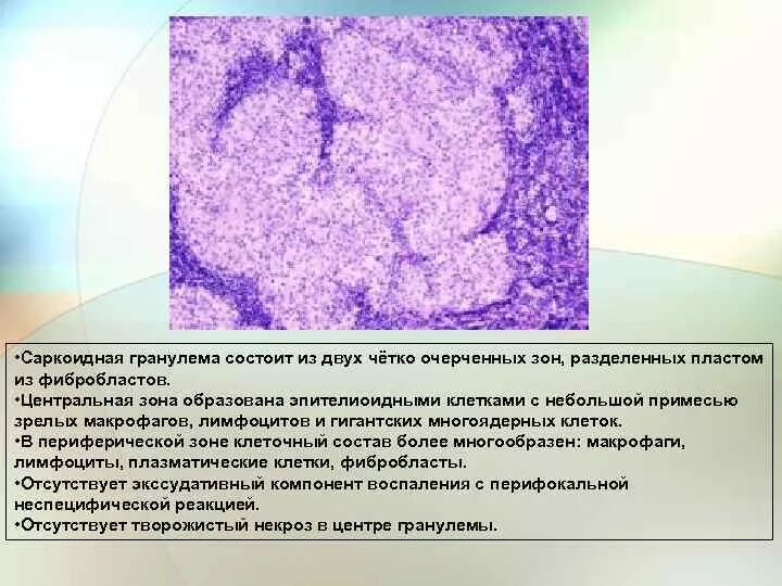 Гранулематозное воспаление патанатомия. Зоны гранулемы. Зоны гранулемы. Зоны гранулемы. Клеточный состав туберкулезной гранулемы.