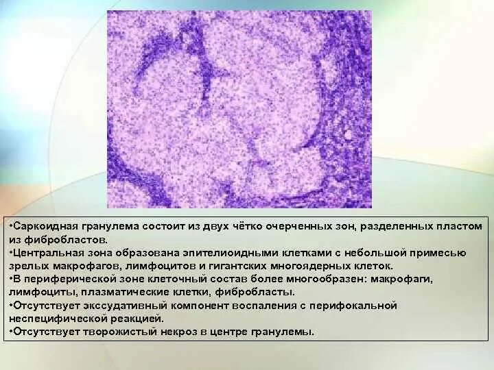 Компоненты саркоидной гранулемы. Саркоидная гранулема гистология. Саркоидная гранулема морфология. Саркоидная гранулема