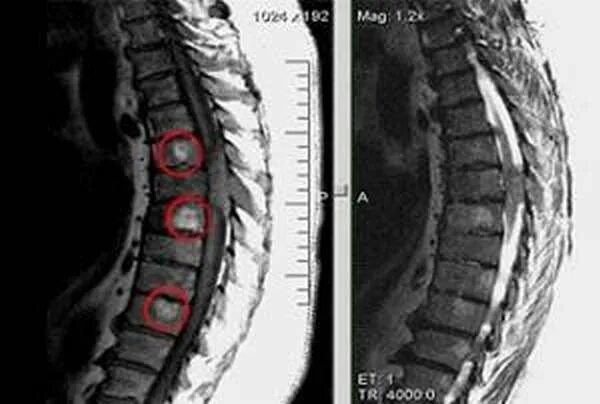 Опухоль спинного мозга кт позвоночника. Метастазы в грудном отделе позвоночника на кт. Метастатическое поражение позвоночника на мрт.