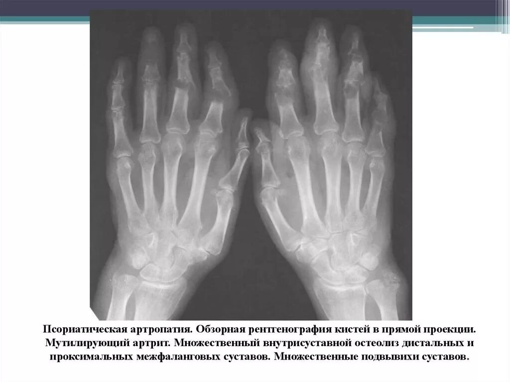 Артропатия код. Псориатический артрит кистей рентген. Мутилирующий псориатический артрит рентген. Ревматоидный артрит кисти рентген. Псориатический артрит (артропатия).