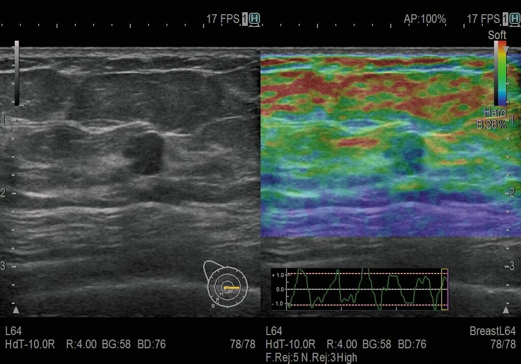 Компрессионная эластография молочных желез. Эластография молочных желез шкала. Эластография молочных желез протокол. Компрессионная эластография зеленое молочной железы.