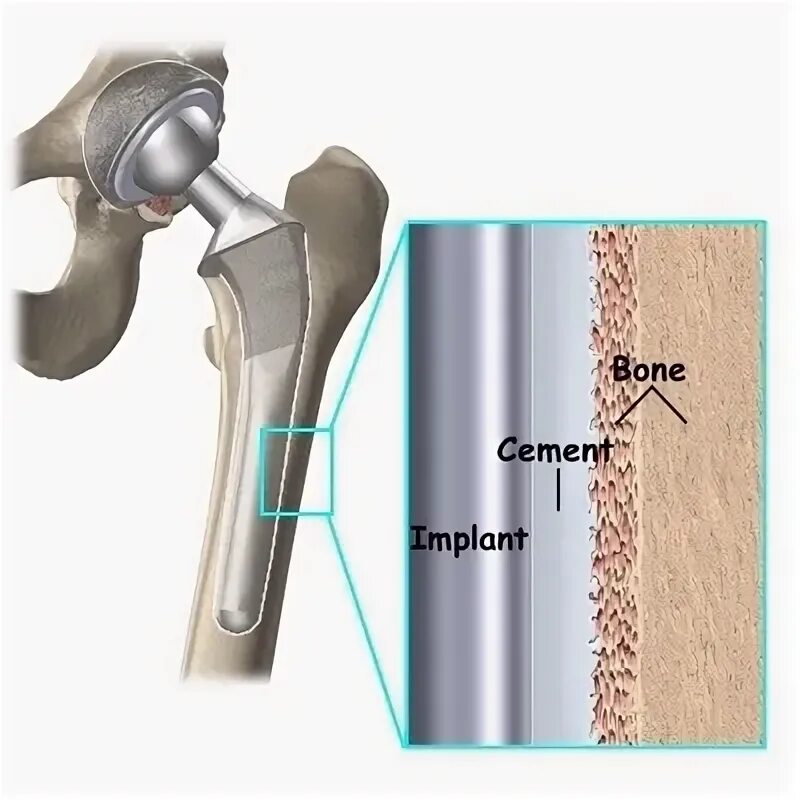 Эндопротез тазобедренного сустава цементной фиксации. Цементная фиксация эндопротеза тазобедренного сустава. Тотальный бесцементный эндопротез тазобедренного сустава. Эндопротезирование тазобедренного сустава с цементной фиксацией. Замена т б сустава