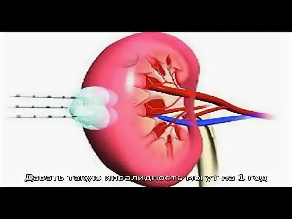 Сколько дают за почку. Резекция почки послеоперационный период. Резекция почки дают ли инвалидность. Экстракорпоральная резекция почки. Резекция почки лапа.