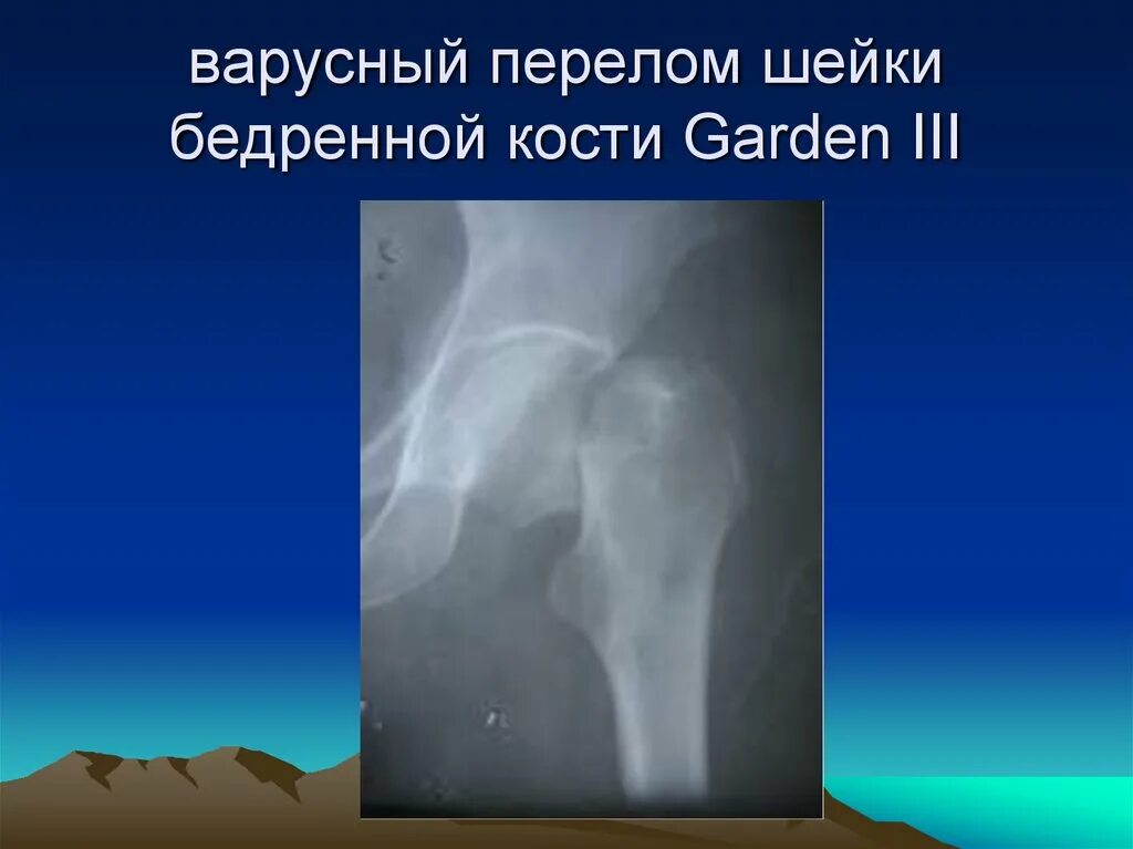 Субкапитальный перелом шейки бедра рентген. Субкапитальный перелом шейки бедренной кости. Варусный перелом шейки бедренной кости. Вколоченный перелом шейки бедра рентген. Трещина шейки