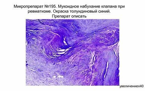 Мукоидное набухание это