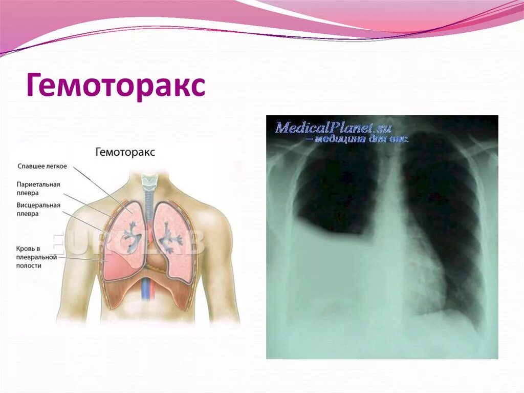 Пневмоторакс гидроторакс гемоторакс. Паракостальный гемоторакс?. Средний гемоторакс рентген. Наличие крови в плевральной полости