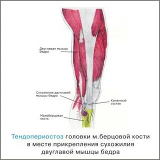 Растяжение сухожилия четырехглавой мышцы бедра