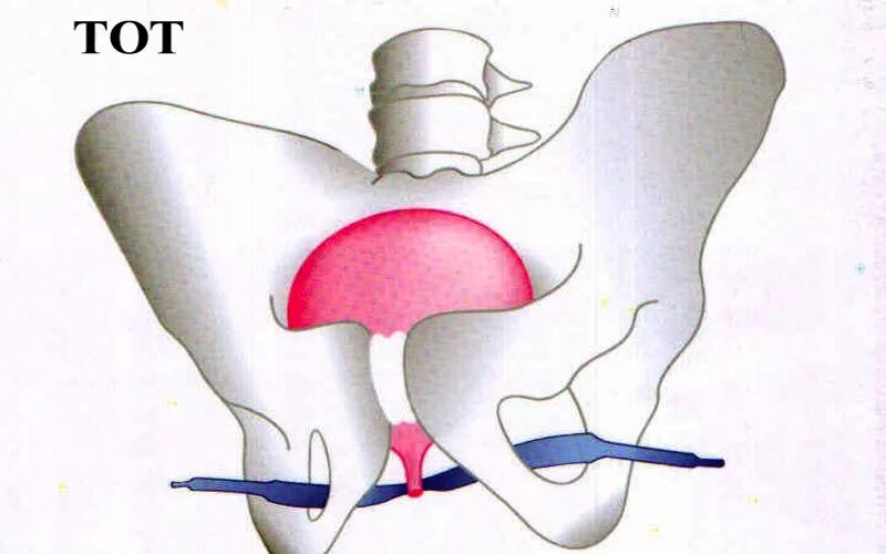 Недержание после удаления матки. Операция TVT-O при недержании. TVT операции при недержании мочи. Слинговая операция TVT при недержании мочи. Операция TVT-O при недержании мочи у женщин.