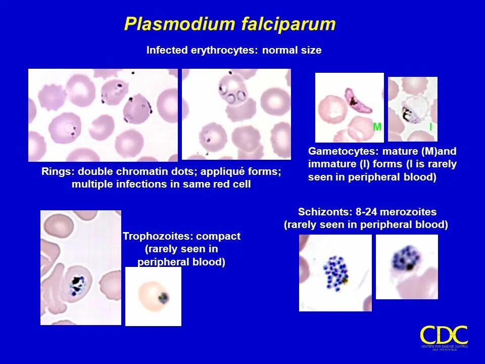 Plasmodium falciparum гаметоцит. Малярия шизонт. Плазмодий фальципарум строение. Плазмодиум малярия строение. Тяжелое течение малярии ассоциируется чаще