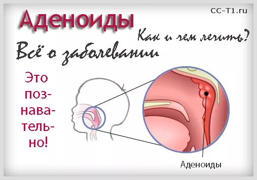 Аденоиды народное лечение. Аденоиды 2-3 степени у ребенка. Аденоиды 2 степени у ребенка.