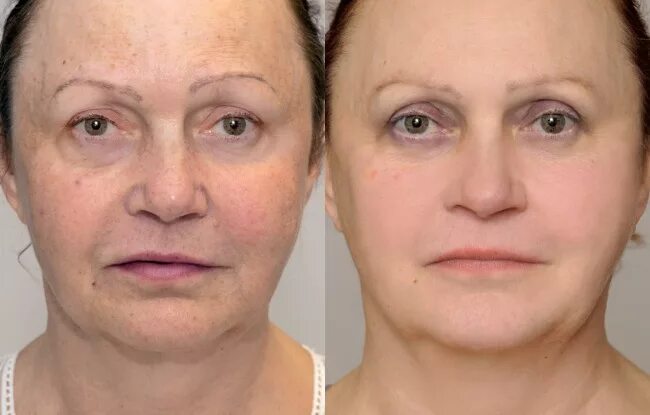 Гиалуроновая кислота для лица уколы. Филлеры в носогубные складки. Филлер под глаза от морщин. Филлеры для лица. Заполнение носогубных складок до и после.