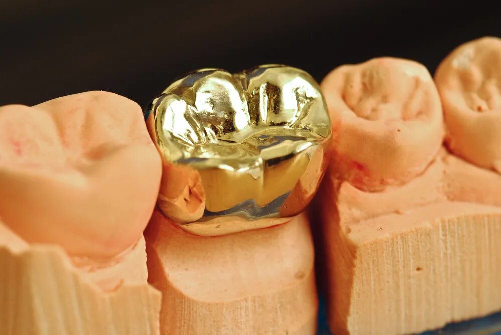 литые коронки на зубы. литые коронки на зубы. коронка цельнолитая (сплав remanium). литые коронки на зубы. мостовидные протезы металл цельнолитые.