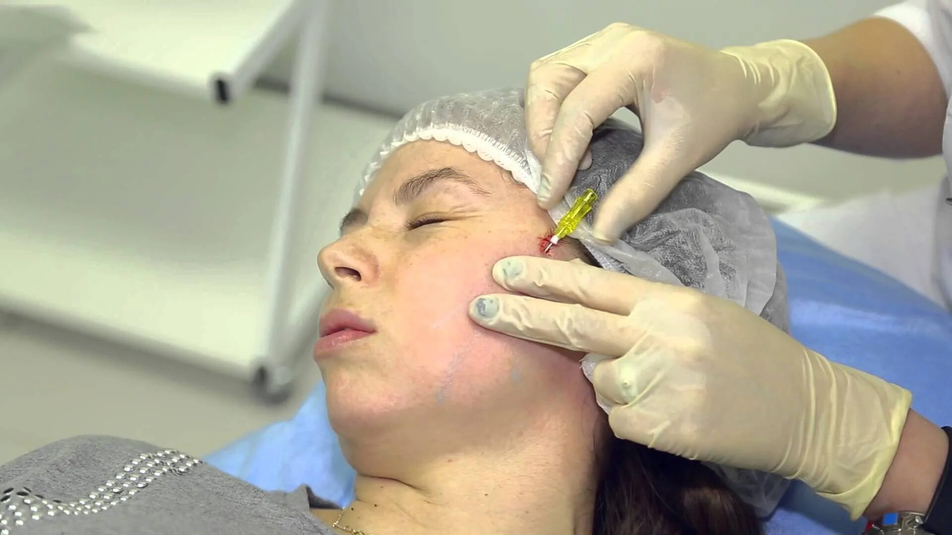 мезонити pdo mono. канюльная техника в косметологии. мезонити для лица. тредлифтинг нити аптос. мезонити для лица.