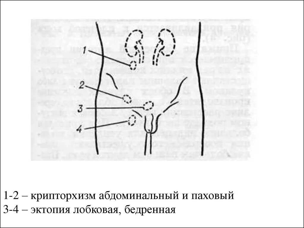 Крипторхизм паховая ретенция. Абдоминальный крипторхизм. Крипторхизм эмбриогенез. Яички в брюшную полость