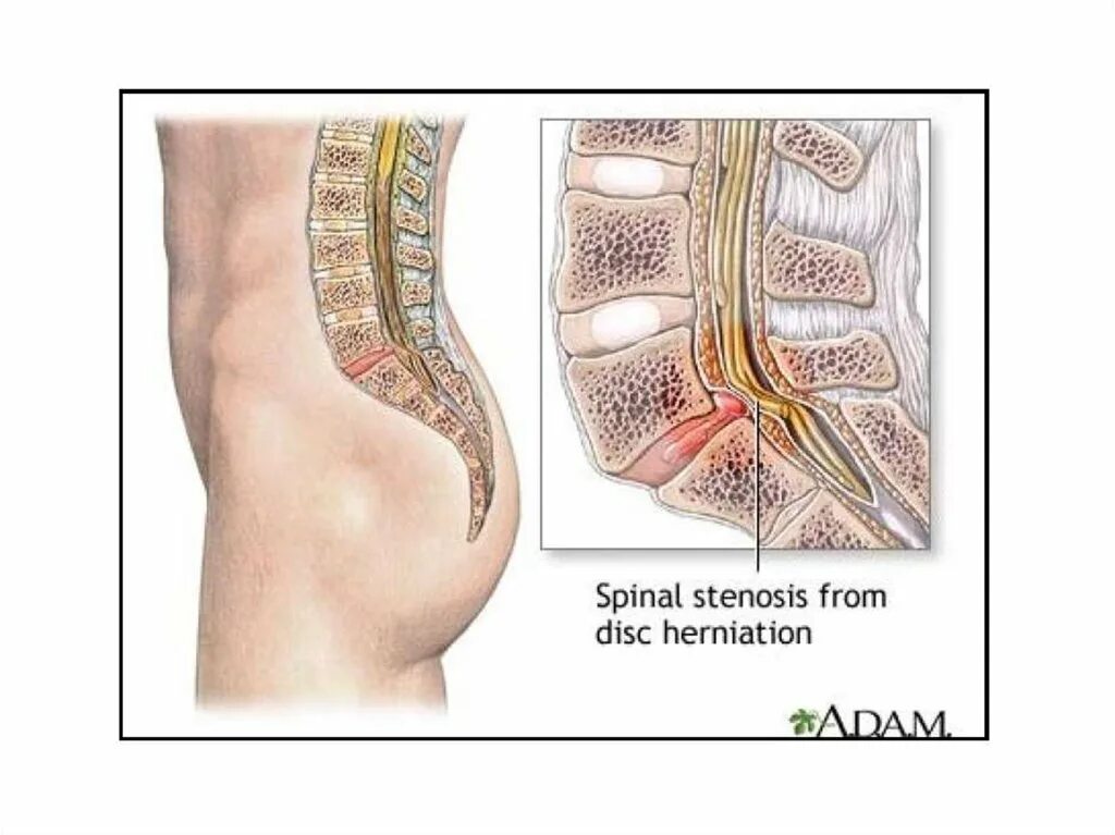Грыжи поясничного отдела позвоночника у женщин. Грыжа пояснично-крестцового отдела. Грыжа позвоночника поясничного отдела. Спинная грыжа. Грыжа позвоночника поя.