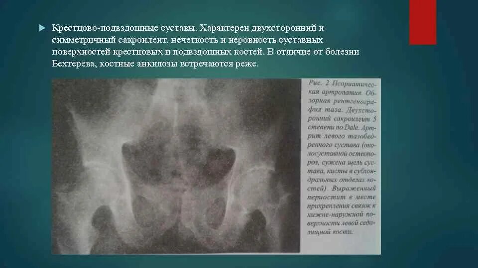 Болезнь бехтерева тазобедренных суставов. Болезнь бехтерева рентген сакроилеит. болезнь бехтерева крестцово подвздошное сочленение. рентген болезнь бехтерева крестцово подвздошное сочленение. сакроилеит при болезни бехтерева.