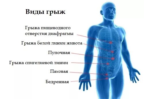 Какие есть грыжи