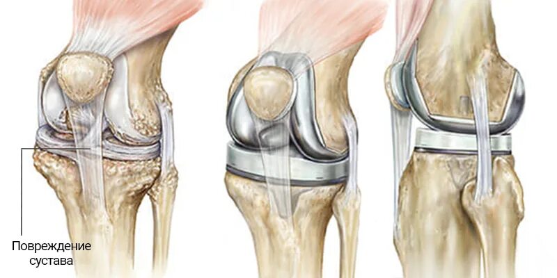 Замена коленного сустава в россии