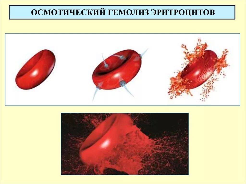 Распад эритроцитов. Гемолиз эритроцитов в крови. Гемолиз крови физиология. Осмотический гемолиз эритроцитов. Причины осмотического гемолиза эритроцитов.