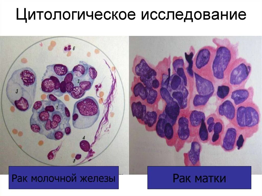 Техника взятия жидкостной цитологии. Метод забора жидкостной цитологии. Методы цитологического исследования шейки матки. Жидкостная цитология результаты. Цитологическое исследование методом жидкостной цитологии.