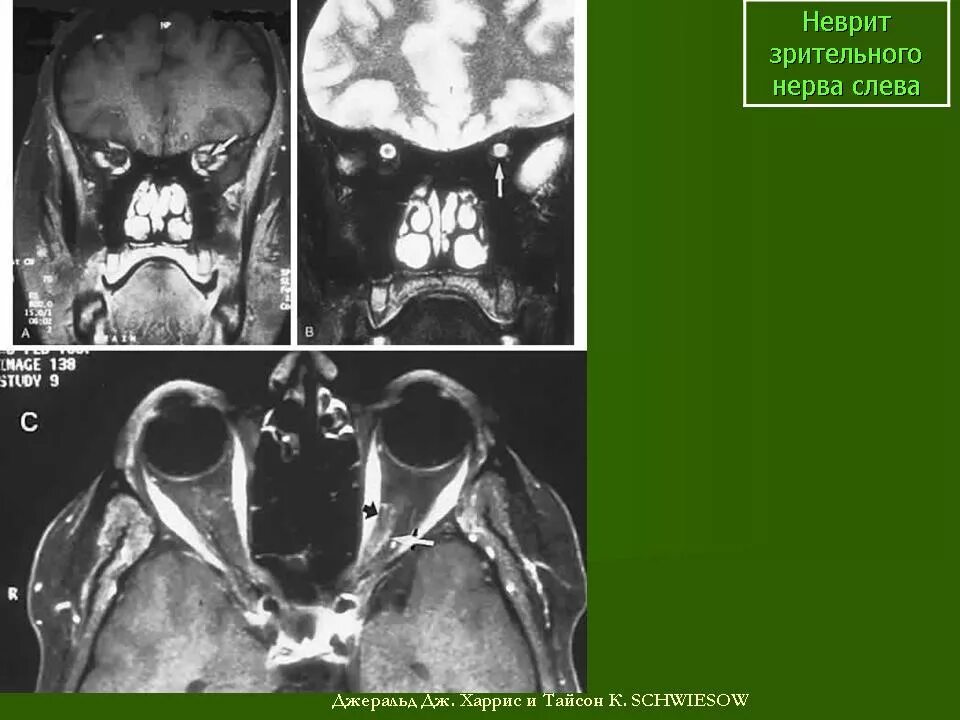 Мрт глазного нерва. Ретробульбарный неврит мрт. Неврит зрительного нерва мрт. Ретробульбарный неврит зрительного нерва мрт. Невринома зрительного нерва мрт.