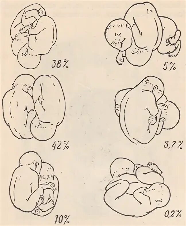 Положение плода в животе. Поперечное предлежание плода. Головное предлежание двойни. Положение и предлежание двойни. Поперечное предлежание близнецов.