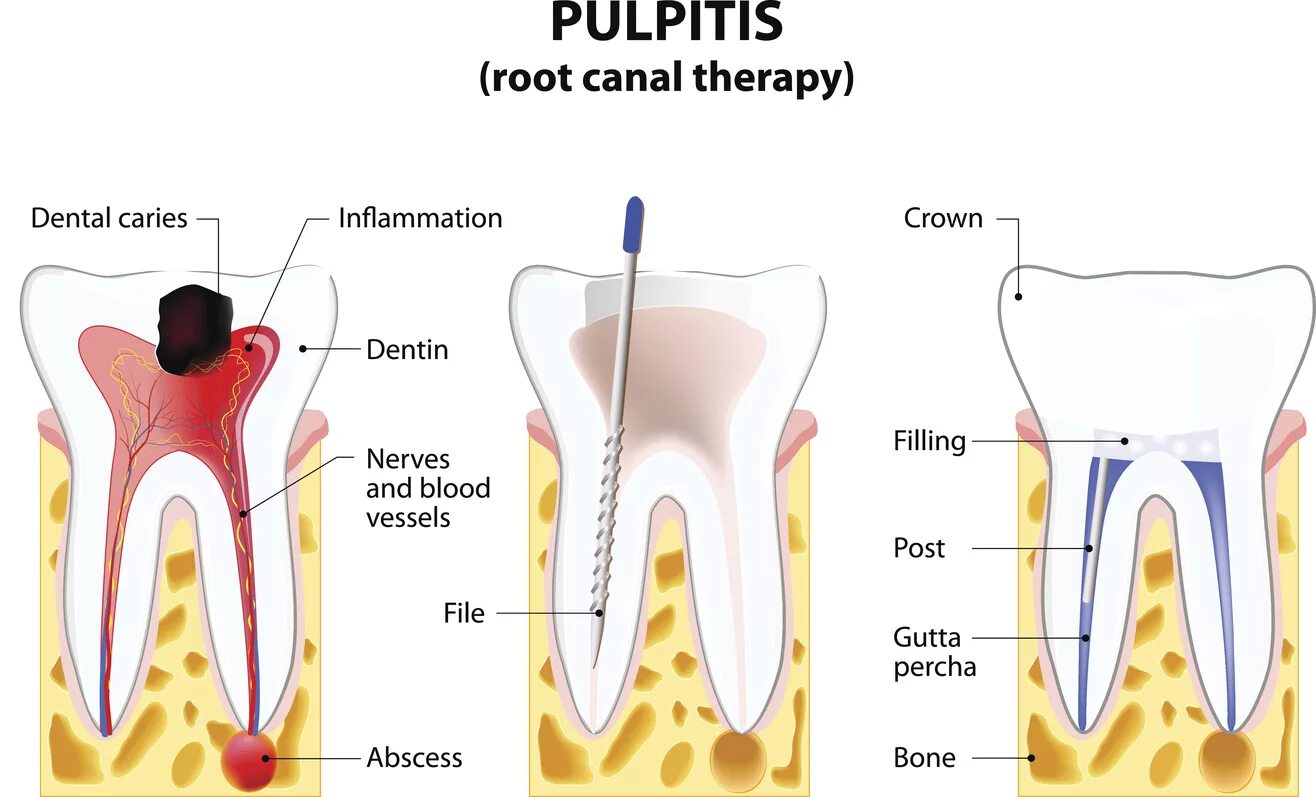 Root canal. Пульпит 2 канального зуба. Пульпита (депульпирование зуба.