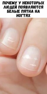 Почему на ногтях белые пятнышки