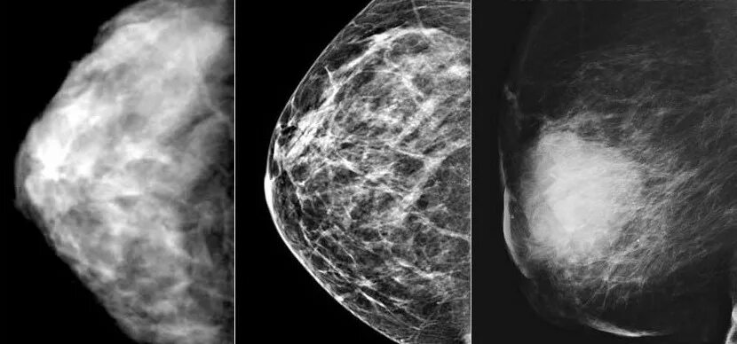 Округлые образования в молочной железе. Фиброаденоз маммография. Опухоль молочной железы маммограмма. Маммография рентген молочной железы. Рик молочной железы маммографич.
