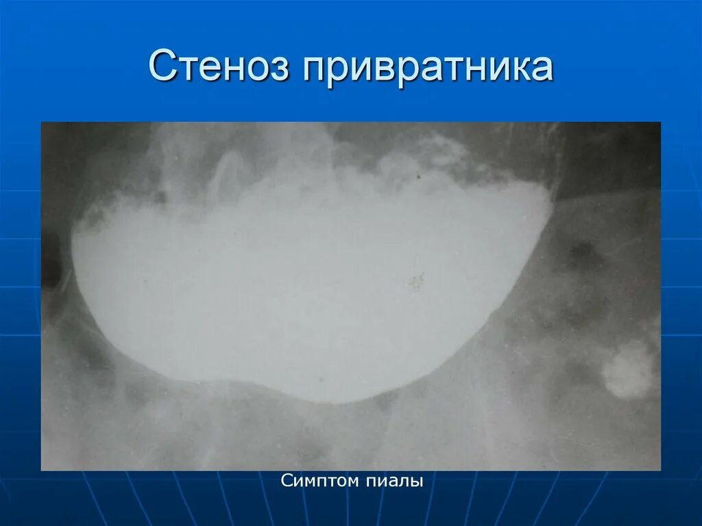 Декомпенсированный стеноз привратника рентген. Субкомпенсированный стеноз привратника. Стеноз привратника симптомы. Стеноз прямой