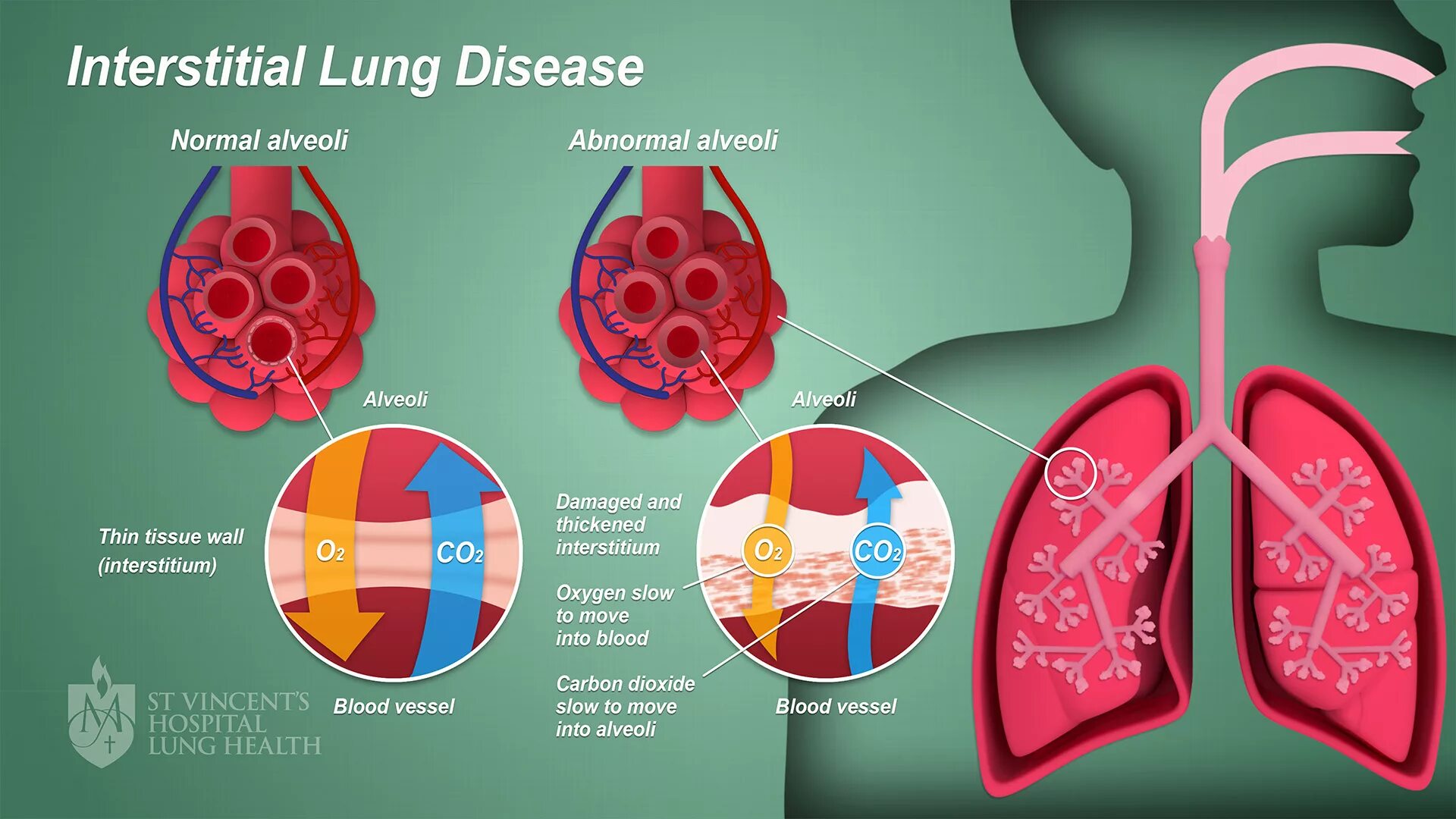 Pulmonary Fibrosis - Interstitial lung diseases. Фиброз интерстициальной ткани лёгких.