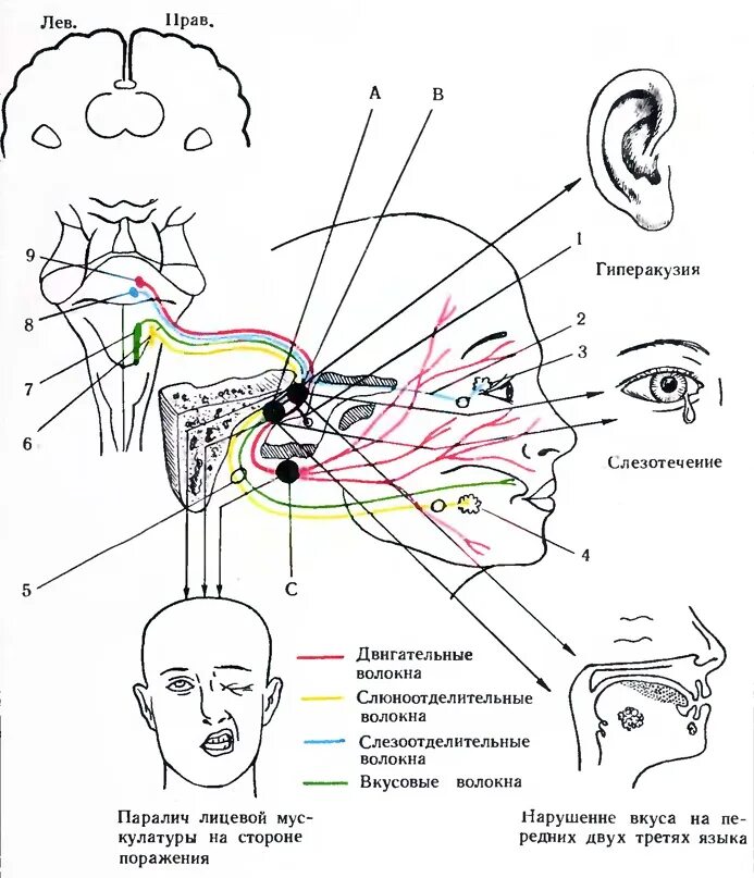 Ветви тройничного нерва схема. Поражение лицевого нерва схема. Ядра лицевого нерва схема. Паралич лицевого нерва схема. Левый лицевой нерв