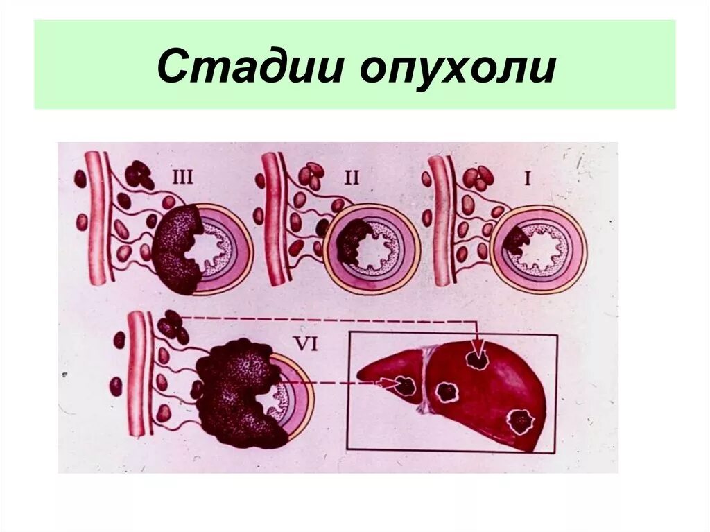 Фазы развития злокачественной опухоли. Стадии развития злокачественных опухолей. Стадии злокачественной опухоли. Степени развития злокачественных опухолей. Возникновения злокачественных новообразований