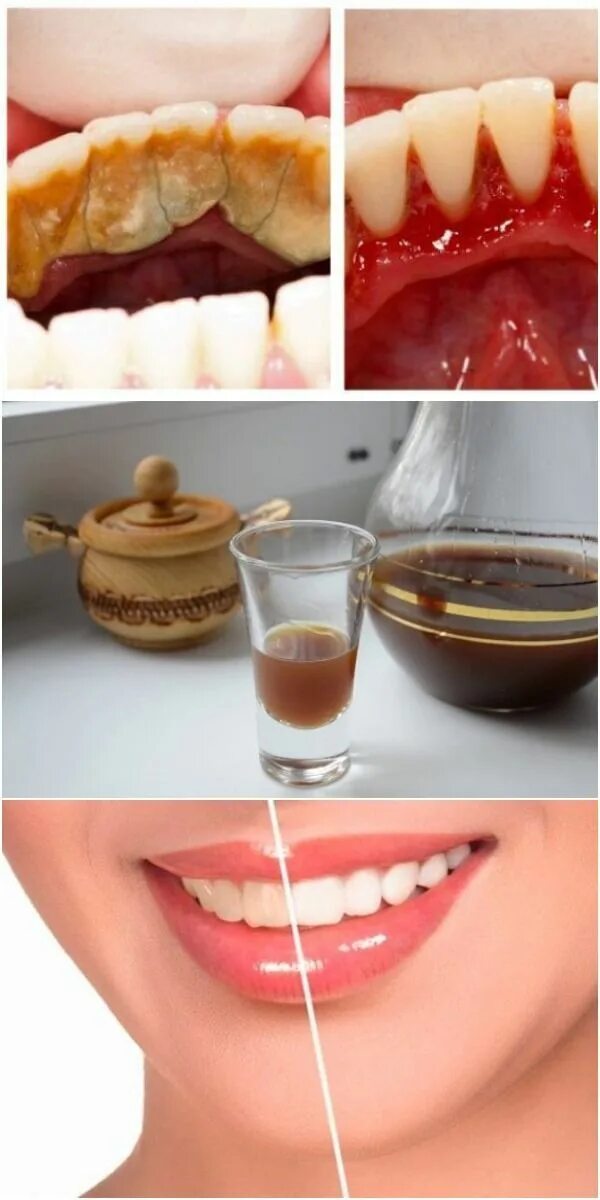 Pin en odonto Caries dental, Limpieza dental, Cuidado dental