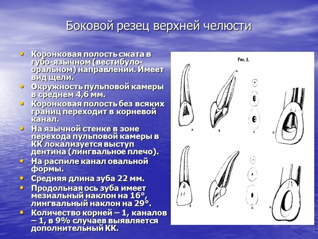 Зуб боковой резец. Эндодонтия бокового резца верхней челюсти. Верхний боковой резец анатомия. Верхний Центральный резец анатомия. Центральный медиальный резец верхней челюсти.