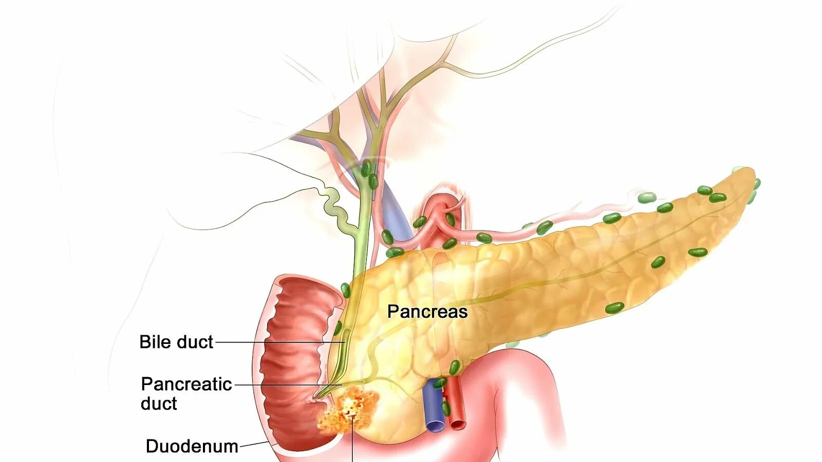 4 стадия поджелудочной железы сколько живут. Панкреатический проток поджелудочной железы. Поджелудочная и холедох. Поджелудочная железа у женщин. Холедох анатомия.