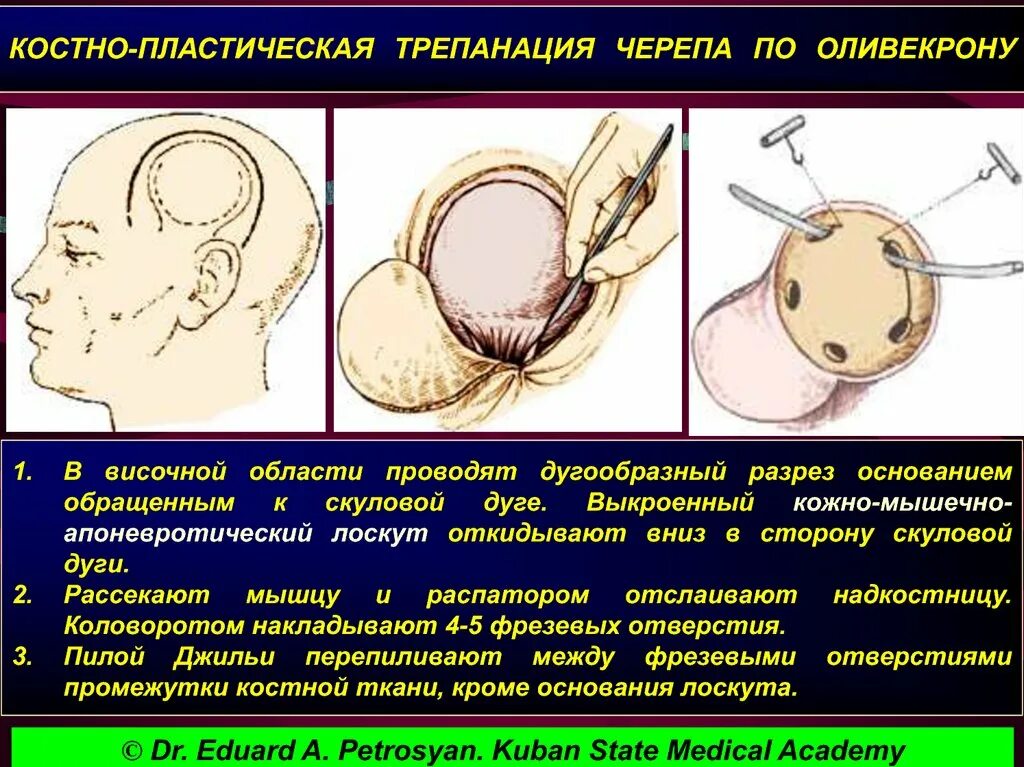 Костно-пластическая Трепанация черепа по Оливекрону. Костно-пластическая Трепанация черепа ход операции. Принципы костно-пластической и резекционной трепанации черепа. Топографическая анатомия костно-пластическая Трепанация черепа.