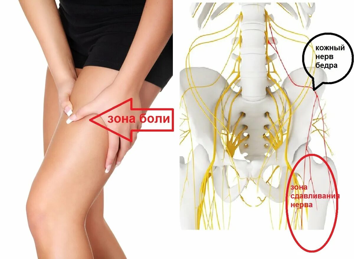 Половой нерв симптомы у женщин. Синдром рота-Бернгардта. Парестетическая мералгия Бернгардта-рота. Невропатия латерального кожного нерва бедра. Неврит наружного кожного нерва бедра.