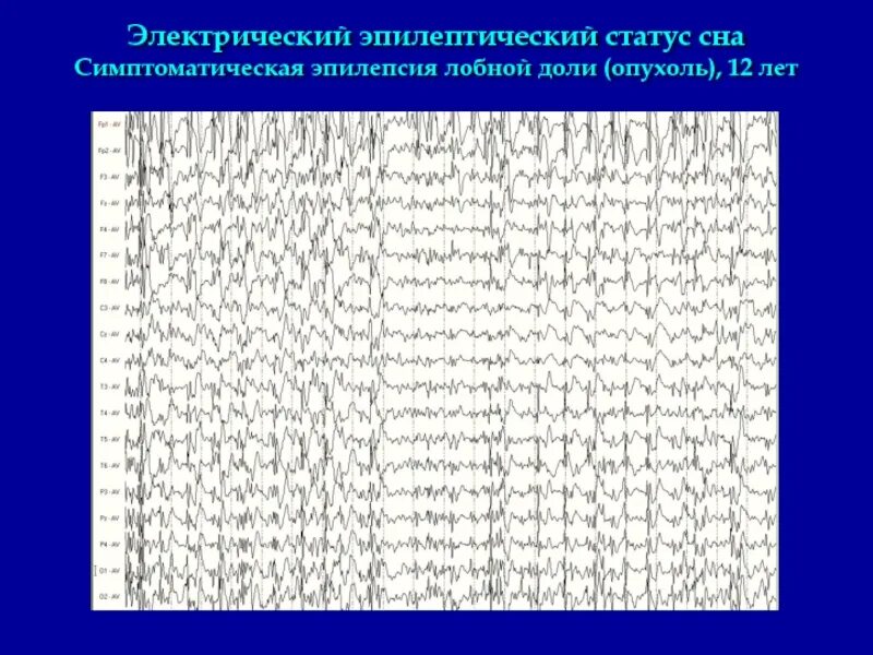 Припадок сна. Юношеская абсанс эпилепсия ЭЭГ. Эпистатус на ЭЭГ. Миоклоническая эпилепсия ЭЭГ. Иктальный паттерн на ЭЭГ при эпилепсии.