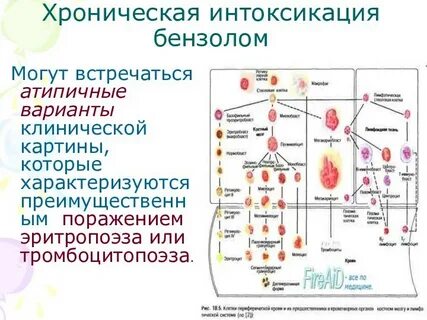 Хроническая интоксикация бензолом