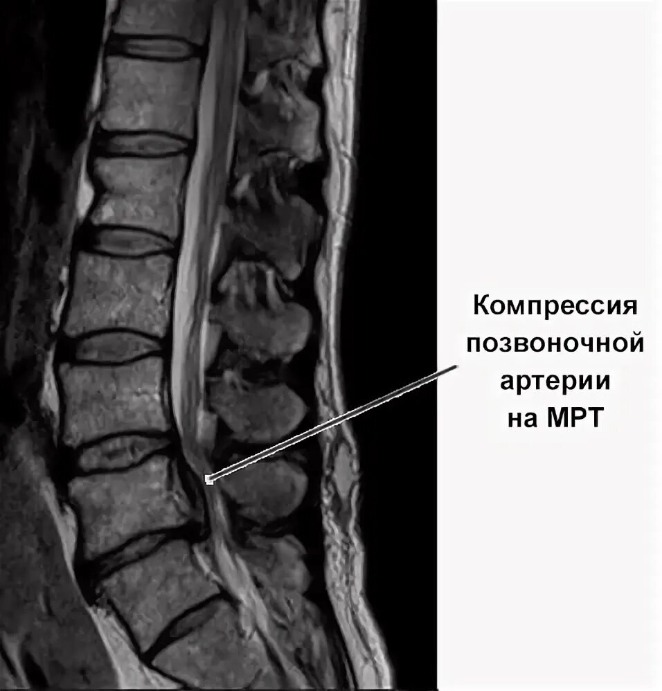 Компрессия левой артерии