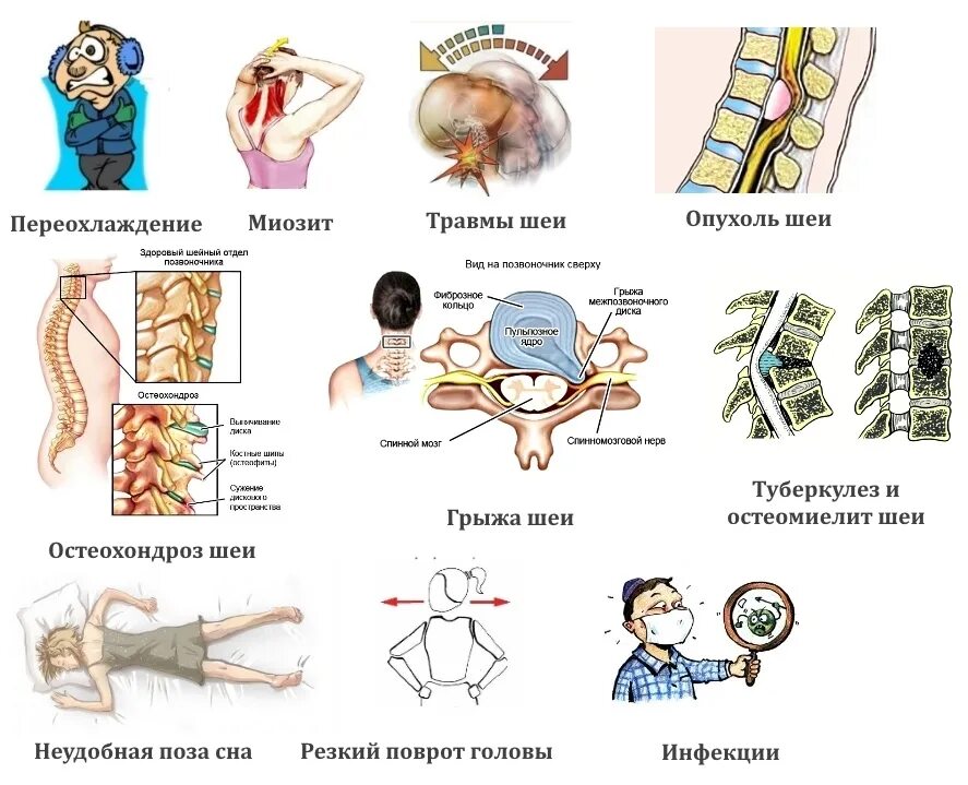 Защемило правую сторону шеи что делать. Шейный остеохондроз. Болит шея после сна.