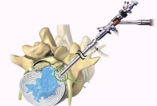 Грыжа межпозвонкового диска операция. Эндоскопическая дискэктомия грыжи позвоночника. Эндоскопическая дискэктомия поясничного отдела позвоночника. Эндоскопическая операция грыжи позвоночника. Операция на дисках позвоночника