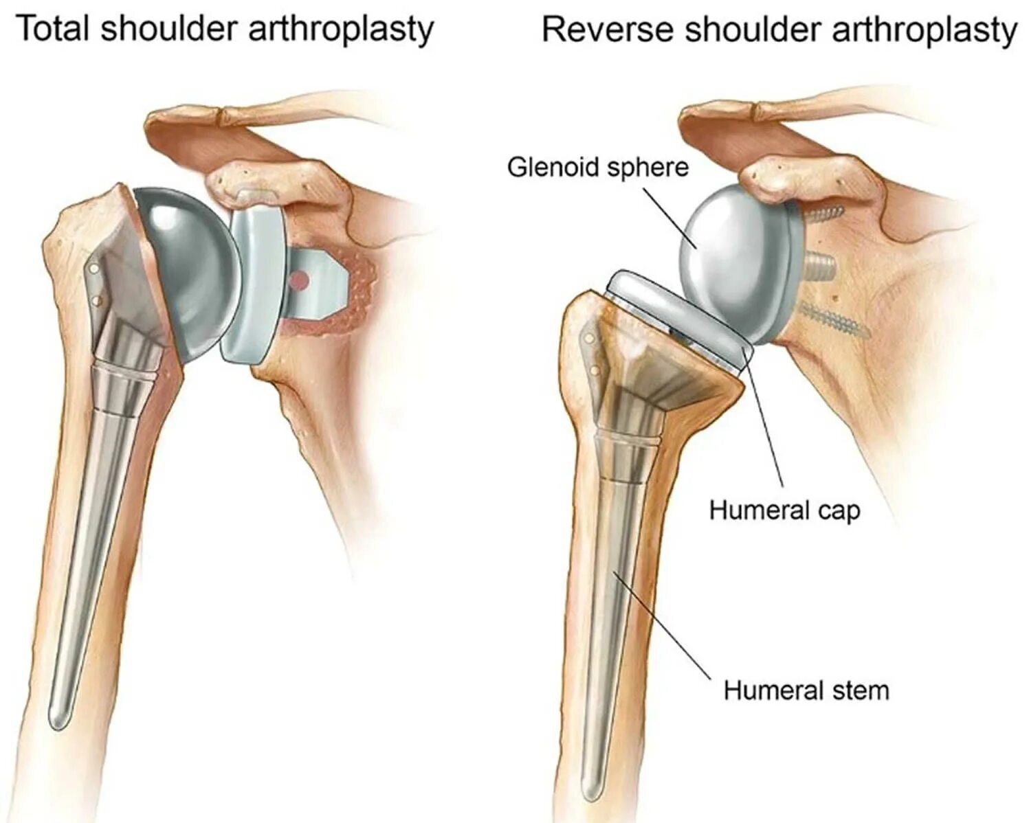 Реверсивный эндопротез плечевого сустава. Эндопротез плечевого сустава Тотальный реверсивный. Рентген эндопротеза плечевого сустава. Анатомия плечевого сустава fra.