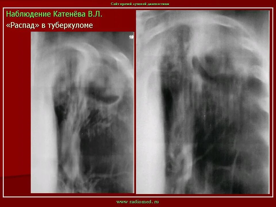 Кальцинированная туберкулома. Солитарная туберкулома. Туберкулома в фазе распада рентген. Распад туберкуломы. Распад туберкуломы.