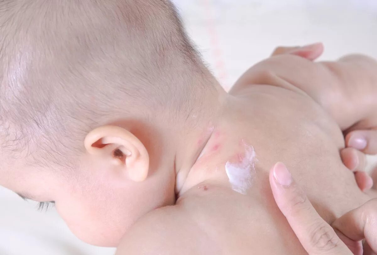 Пищевая аллергия у грудничка. Аллергия у новорожденного ребенка. Пищевая аллергия у новорожденного грудничка.