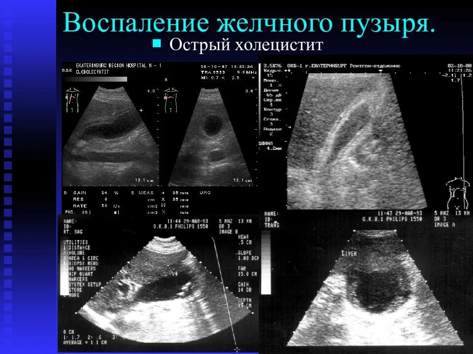 Как лечится желчный пузырь