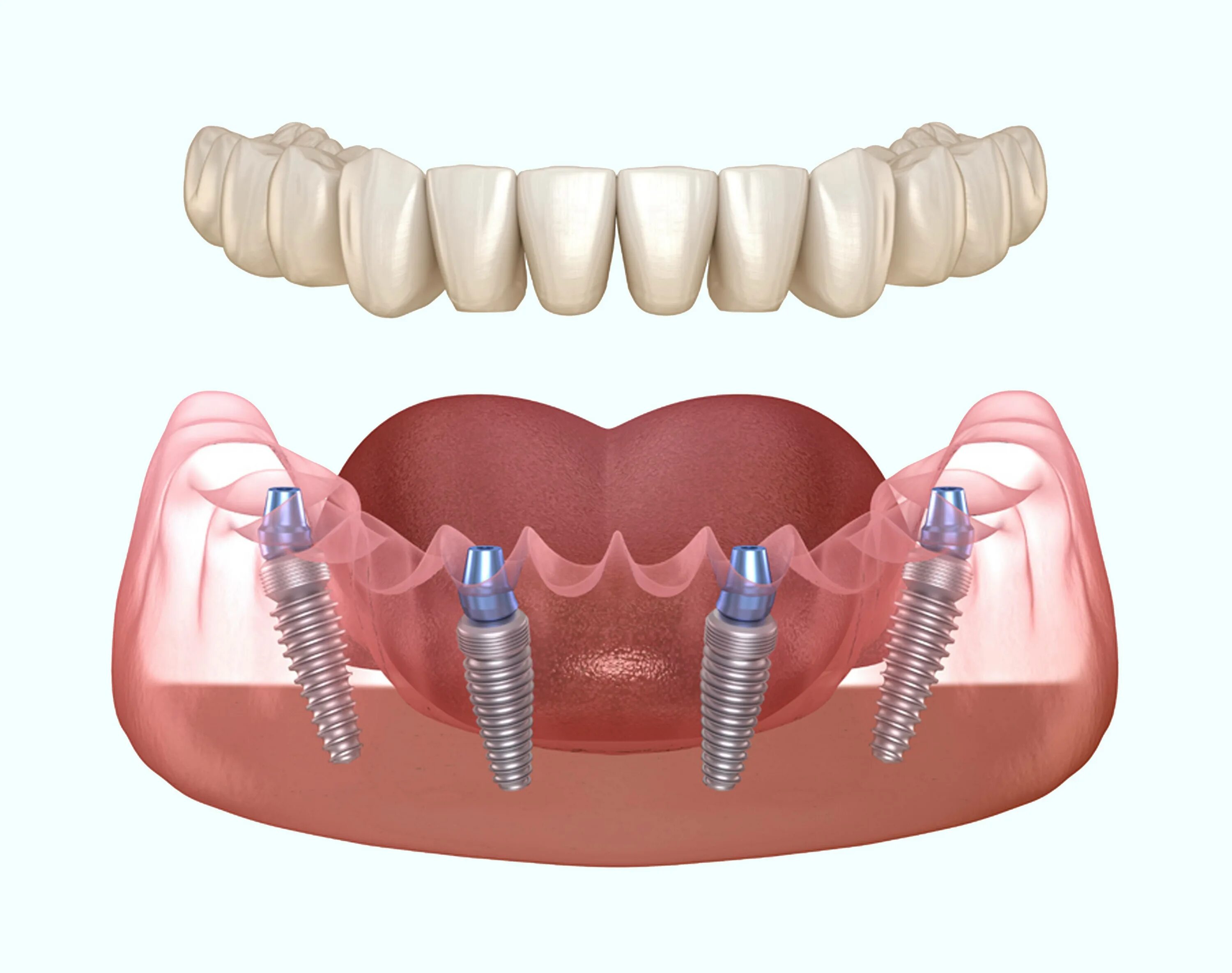 Имплантация "all-on-4" Lenmiriot (Россия). Имплантация зубов all on 4. Технология протезирования зубов all-on-4. Имплант зуба Osstem. Имплантация sup aznona com