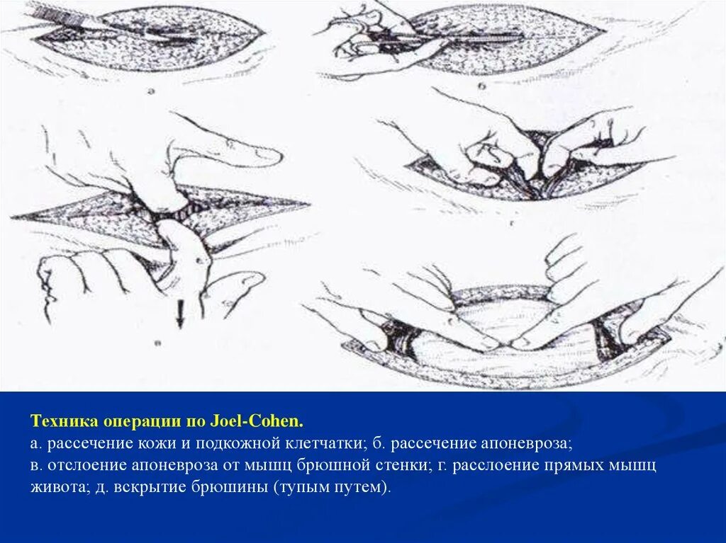 Джоэл-Кохену кесарево сечение. Техника кесарева сечения по Джоэл-Кохену. Лапаротомия по Джоэл-Кохену. Шов кесарева сечения по Джоэл Кохену. Техника кесарева сечения